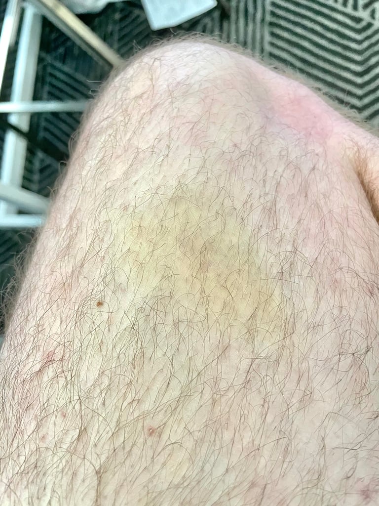 my nasty bruise